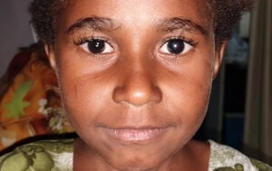 6-year-old Monica from Papua New Guinea needs sight-saving cataract surgery,