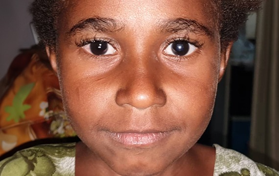 6-year-old Monica from Papua New Guinea needs sight-saving cataract surgery,