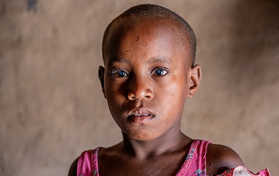 Child Sponsorship. 7-year-old Rita from Uganda needs sight-saving surgery to remove her cloudy cataracts.